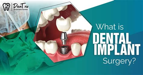 Dental Implant Surgery Guide – DenTru