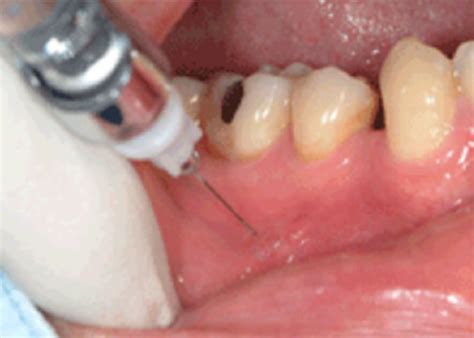 Infiltration Anesthesia 的图像结果