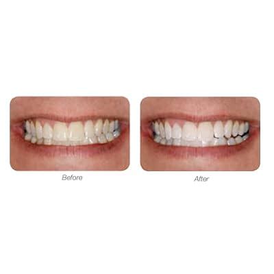 Buy LumiSmile White Take-Home Teeth Whitening Treatment Syringes; Two ...