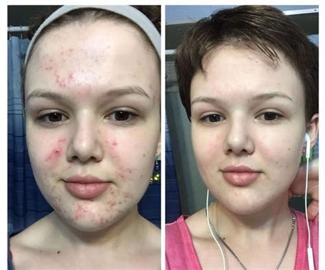 Your Skin Before and After Benzoyl Peroxide; did you know it does this?