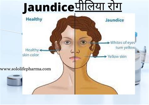 Jaundice || jaundice symptoms || jaundice causes || types of jaundice ...