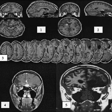 Image result for Prefrontal Cortex Damage