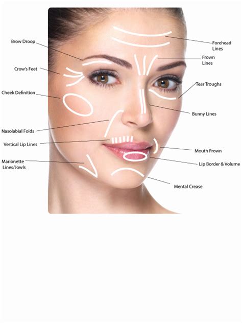 Botox Injection Sites Face Diagram ... | Liquid facelift, Botox injection sites, Botox injections