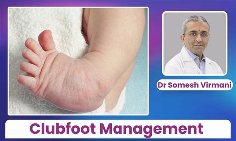 Clubfoot Management in India: Ponseti Method Application - Dr Somesh ...