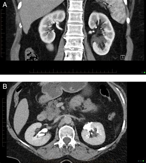 Spontaneous renal calyceal and ureteric rupture secondary to ...