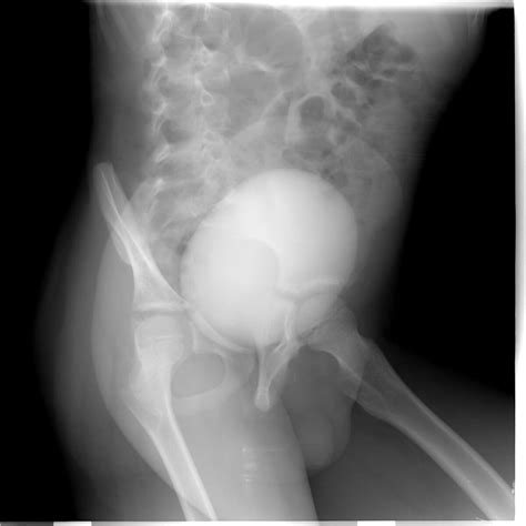 Radiopaedia case Urethral diverticulum id: 23006 study: 23033 - NC Commons