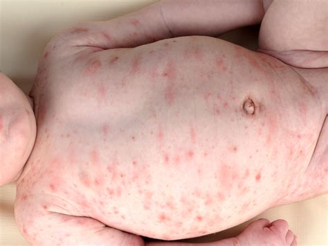 Ringworm Huidziekten