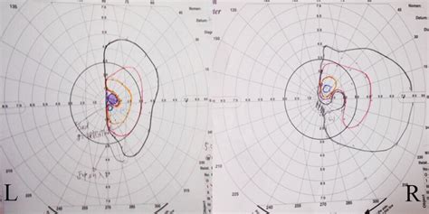 Image result for Contralateral Homonymous Hemianopsia