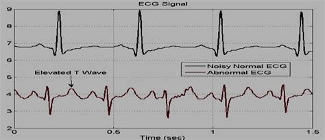 Image result for Normal vs Abnormal ECG