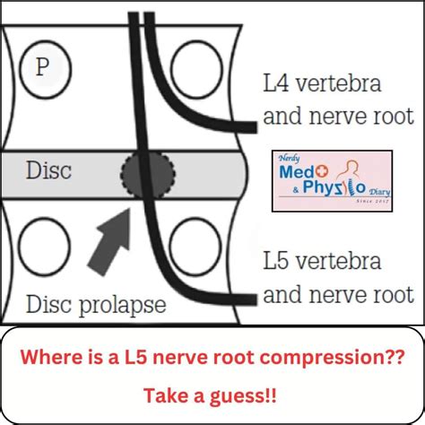 Dott. Francesco Rullo on LinkedIn: Where is a L5 nerve root compression ...