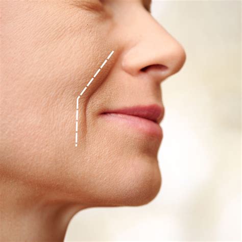 Nasolabial Folds & Marionette Lines – Rejuvenation