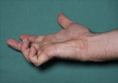 Clinical anatomy of the nerve supply to the upper limb - BJA Education