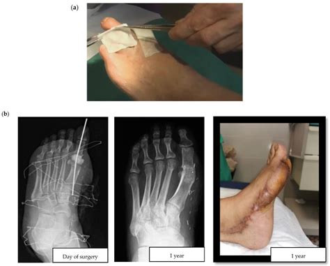 Local Antibiotics in Treatment of Diabetic Foot Infections ...
