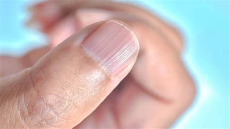Nail Ridges: Here's Why Vertical Or Horizontal Lines Appear On Your ...