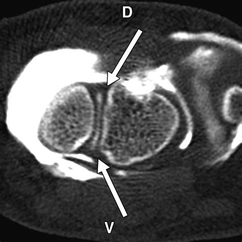 Scapholunate Advanced Collapse and Scaphoid Nonunion Advanced Collapse: MDCT Arthrography ...