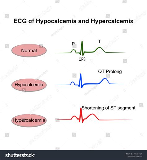Hypercalcemia How To Approach
