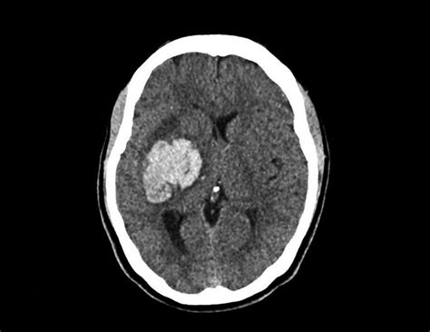 Macht bei hohem Blutdruck ein Schädel - CT oder MRT sinn?
