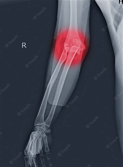 Elbow X Ray Fracture