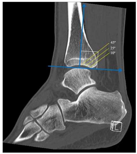 Biomechanical Efficacy of Three Methods for the Fixation of Posterior Malleolar Fractures: A ...