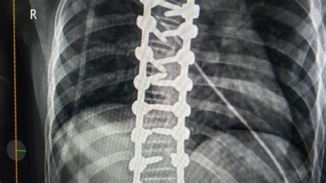 Spinal Cord Injury Awareness Day 2024: 5 ways to keep your spine ...