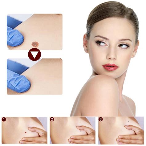 WipeOff Skin Tags & Moles Verrugas Removedor de | Ubuy India