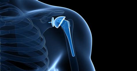 Treatment for Shoulder Pain from Osteoarthritis - Precision Orthopaedic Specialties