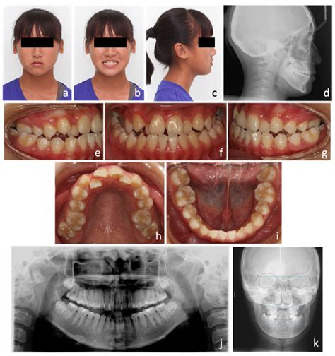 Management of Class III Malocclusion and Maxillary Transverse Deficiency with Microimplant ...