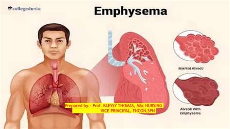 Emphysema Life Expectancy 的图像结果