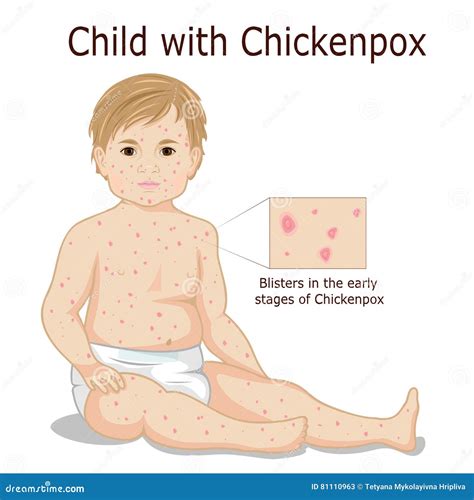 Early Stages Of Chickenpox