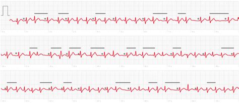 Paf Medical Abbreviation