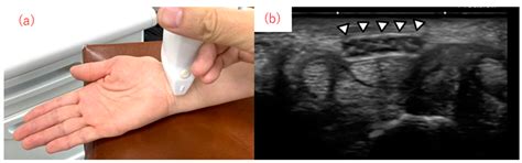 Dynamic Analysis of the Median Nerve in Carpal Tunnel Syndrome from ...