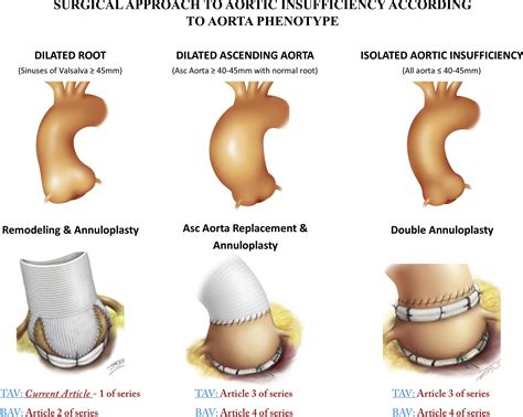 Valve-Sparing Aortic Root Replacement Using the Remodeling Technique With Aortic Annuloplasty ...