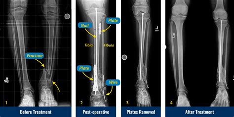 Tibia Fracture Treatment Management Of Complex Open Tibial Plateau