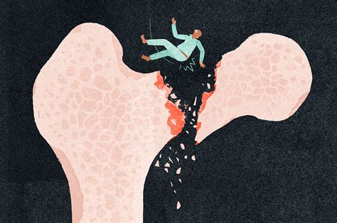 Elderly Broken Hip Recovery Time