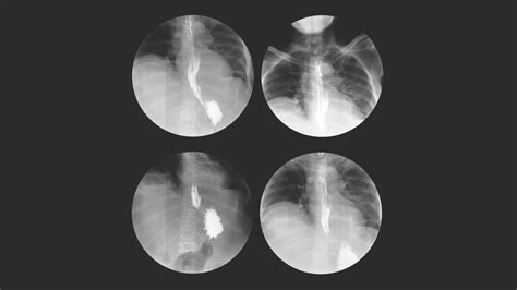 Image result for Modified Barium Swallow Study Basic