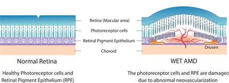 What is Wet AMD? | Wet Macular Degeneration Symptoms & Treatments
