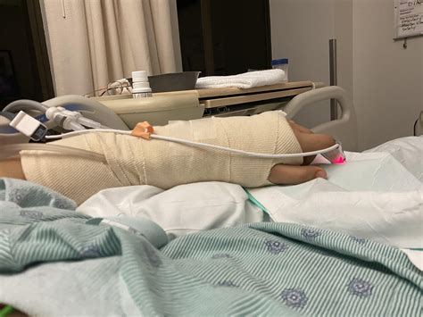 RFF Phallo 24 hours after surgery : r/EverythingPhallo
