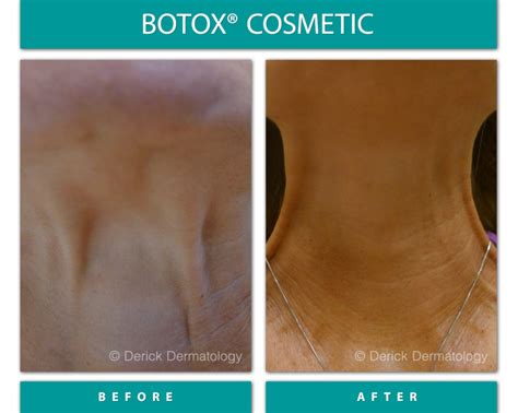 What Botox Looks Like After Years of Use, According to Derms