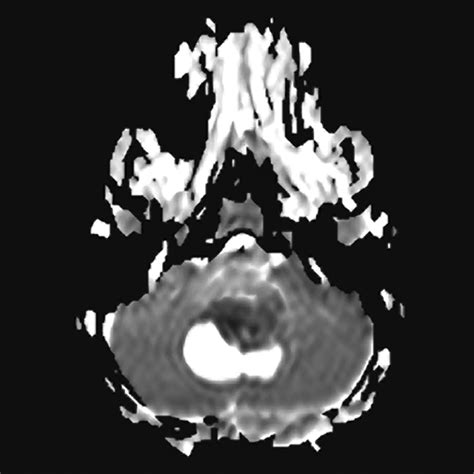 Imaging Characteristics of Atypical Teratoid–Rhabdoid Tumor in Children Compared with ...