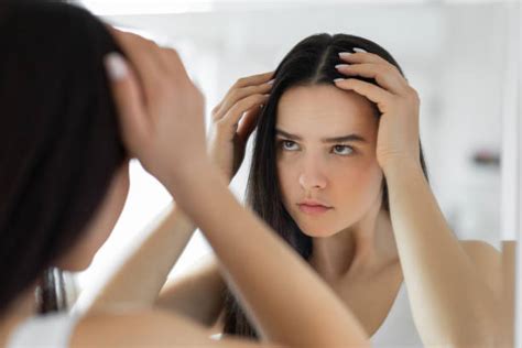Food For Dandruff: Foods That Trigger Dandruff vs Foods That Fight It ...