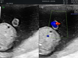 Bildergebnis für 2 vessel umbilical cord ultrasound
