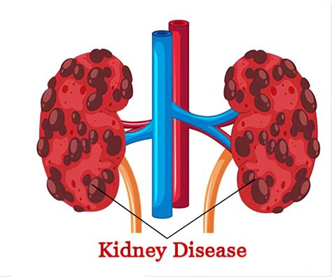 Hair, Nails and Chronic Kidney Disease | American Dialysis ...