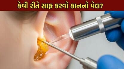 આ રીતે કાઢો કાનથી મેલ, જાતે જ નીકળી જશે પીળી ગંદકી - Doctor tells 3 ...