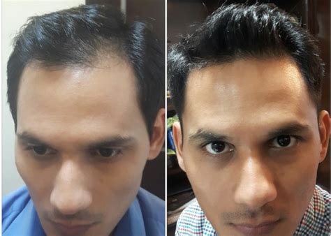 Best Hair Transplant Clinic in Indore, Hair Loss Treatment Doctor in ...