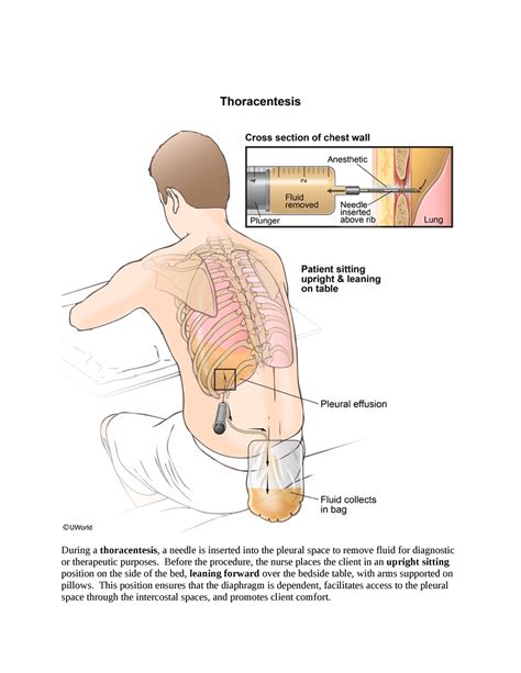 Needle Aspiration Vs Thoracentesis at Paul Craig blog