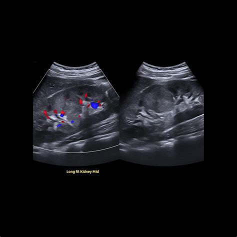 Hypertrophied Column of Bertin | Pediatric Radiology Reference Article ...