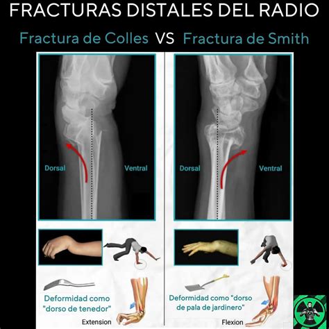 Radiografía De La Fractura De Smith Fracturas Del Radio Distal:
