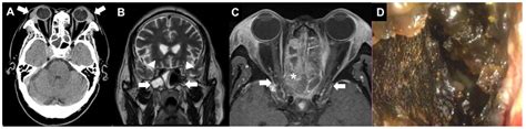 Acute Vision Loss as the Initial Manifestation of Granulomatosis with ...