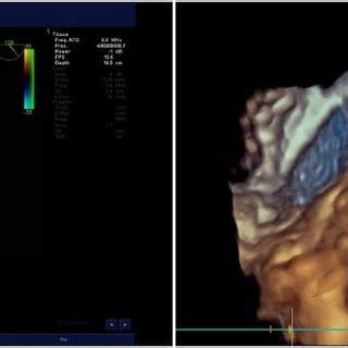 Image result for Nephrectomy Positioning