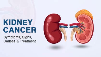 Blog | World of Urology